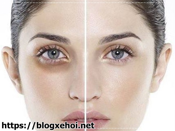 Mắt th&acirc;m quầng l&agrave; bệnh g&igrave; ?